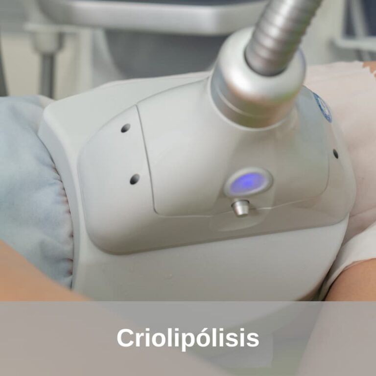 Criolipólisis