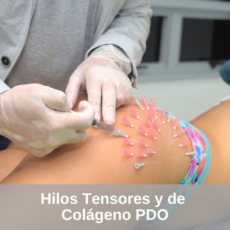 Hilos Tensores y de Colágeno PDO